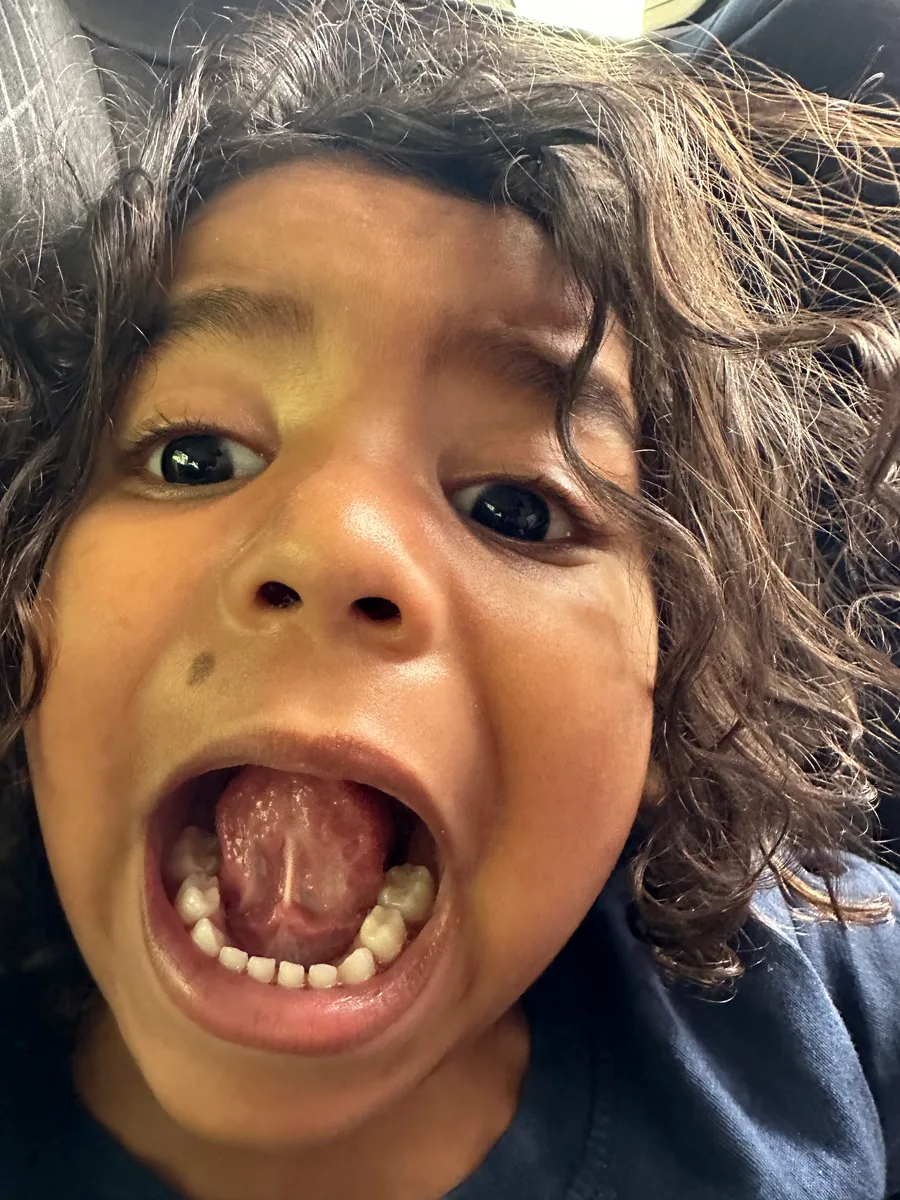 Young child opening wide during a tongue-tie (frenulum) examination.